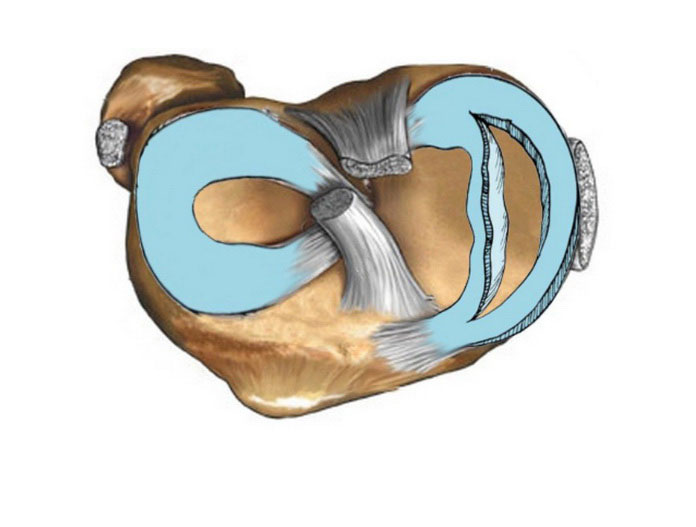 Горизонтальний розрив медіального меніска: яке лікування пропонує сучасна медицина